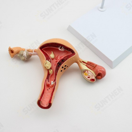 1Pcs Uterus Ovary Anatomical Medical Model Anatomy Cross-Section Science Toy With Base