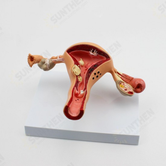 1Pcs Uterus Ovary Anatomical Medical Model Anatomy Cross-Section Science Toy With Base