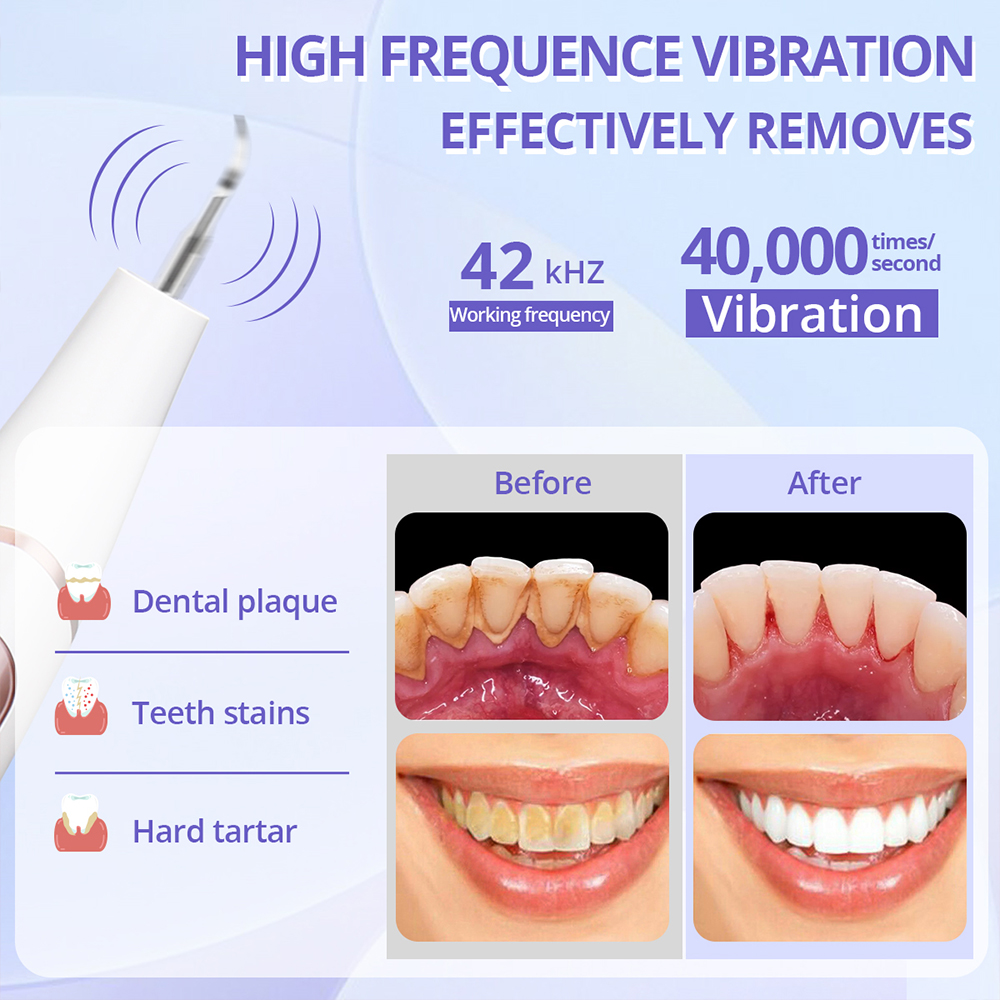 UALANS-Tooth-Scaler-Kit-Electric-Rechargeable-Plaque-Remover-For-Teeth-With-LED-Light-10mins-Timing--1963793-2