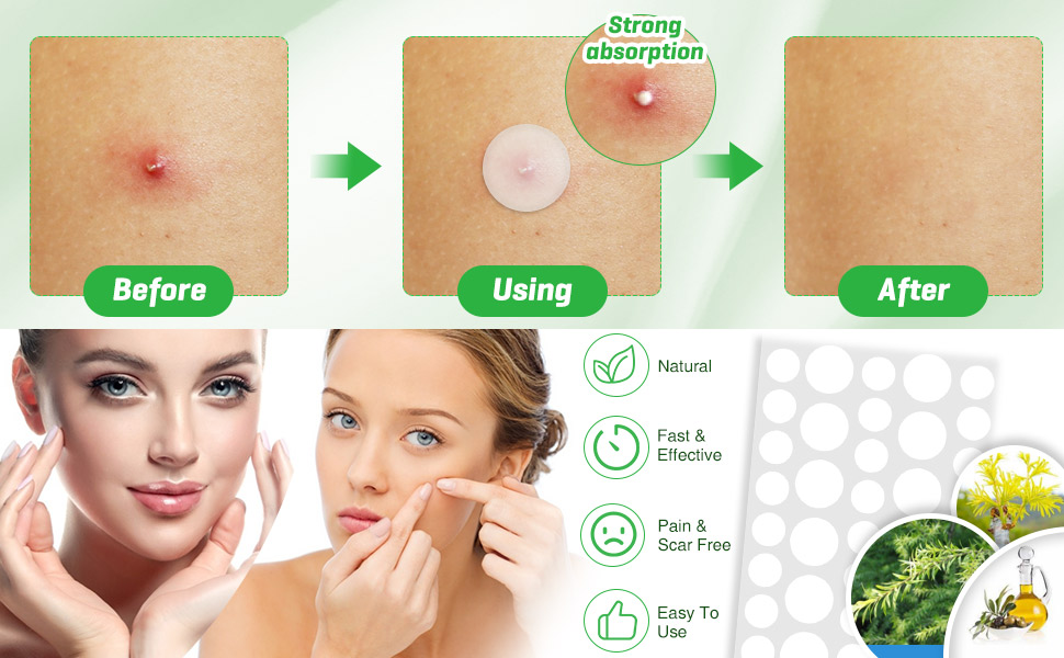108Pcs-Acne-Pimple-Patches-Spot-Repair-Hydrocolloid-Mole-Removal-Face-Sticker-1960445-9