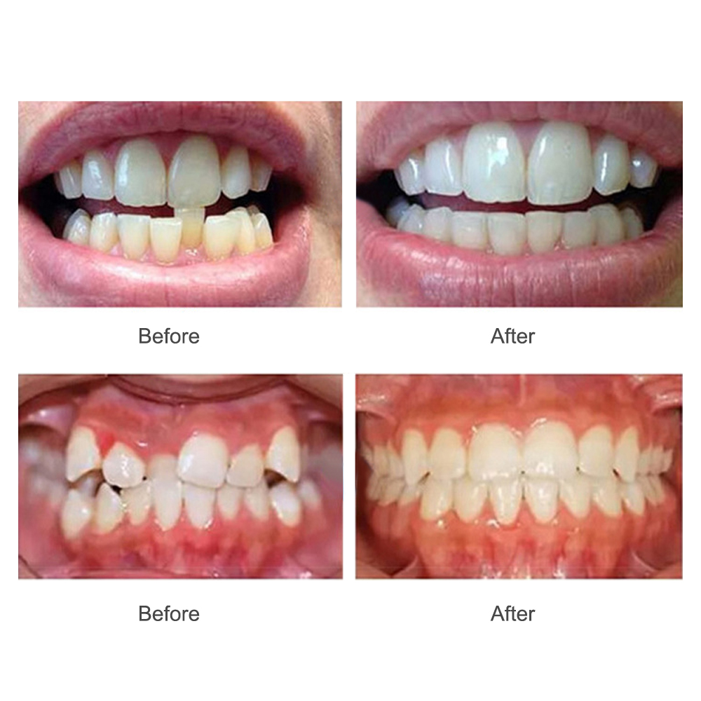 Dental-Orthotics-Teeth-Whitening-Tool-Tooth-Orthodontics-Dental-Braces-Orthodontic-Retainers-Tooth-A-1842740-6