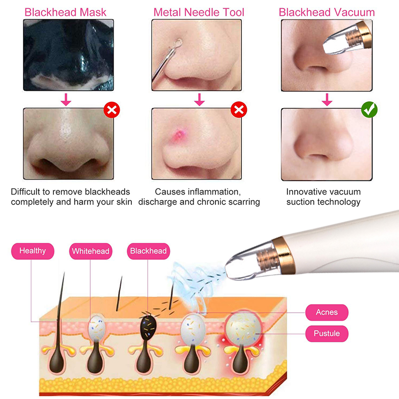 3-Blackhead-Suction-Device-To-Remove-Blackheads-Export-Device-Pore-Cleaner-Beauty-Device-1716562-4