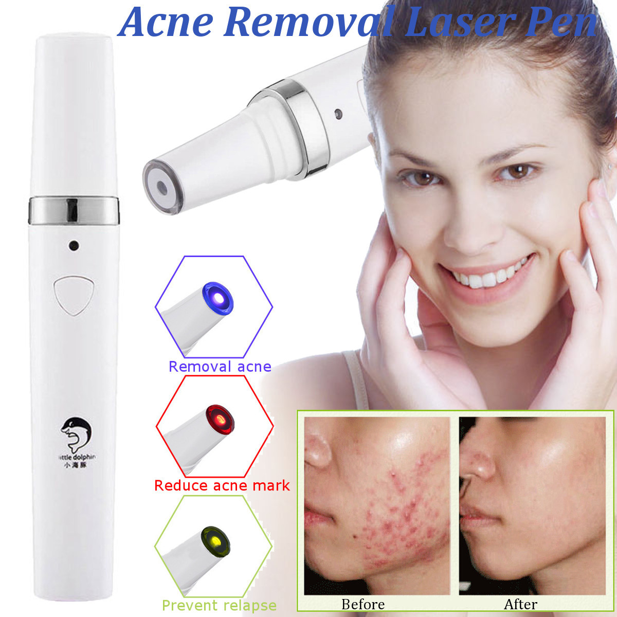 Blue-Red-Green-Light-Therapy-Acne-Laser-Pen-Soft-Scar-Removal-Treatment-Device-Beauty-Machine-1368410-1